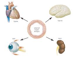 Blodtrykk over 140/90 er høyt blodtrykk. Hoyt Blodtrykk Store Medisinske Leksikon