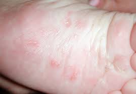 Image result for scabies in the groin area
