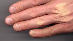 If they have become ragged or the cuticle has starting to grow over your nail, gently push. Onycholysis Symptoms Causes And Pictures
