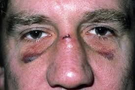 Broken Nose Nhs