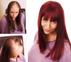 Women with this type of hair loss retain their hairlines and thin diffusely, usually on the top of such treatments should be discontinued if a woman becomes pregnant. Clients Hair Loss Photos Showing A Wide Range Of Conditions Hair Loss Women Roots Hair Hair Growth