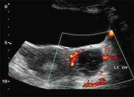 If ultrasound images show the former, further testing will be needed to diagnose cancer. Efficacy Of Color Doppler Ultrasonography In Differentiation Of Ovarian Masses Sehgal N J Mid Life Health