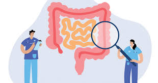 During a biopsy, the doctor takes out a small piece of tissue where the cancer might be. At Home Colorectal Cancer Screening What You Should Know Cedars Sinai