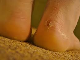 Comment Soigner Les Ampoules Et Les Ecorchures Ameliore Ta Sante Comment Soigner Remedes Pour Les Pieds Traitement De Pieds