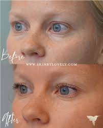 Andalou naturals deep wrinkle dermal filler is developed with natural ingredients that boost cell vitality and promote collagen and elastin development. Dermal Fillers With Before After Photos Skin By Lovely