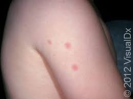 Image result for bedbugs bites