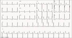 Dewinter group is the premier provider of accounting, finance, & it professional staffing on an executive search, consulting & contract basis. Figure Electrocardiogram Depicting The De Winter Pattern Contributed By Em Vilela Md Statpearls Ncbi Bookshelf