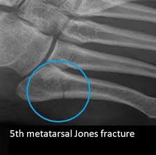 Limit unnecessary walking or standing for the first week to control swelling. 5th Metatarsal Fracture Dr Ben Beamond Orthopaedic Surgeon Adelaide