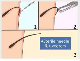 It doesn't look pretty, it's uncomfortable, and it itches. How To Prevent Ingrown Hairs On The Buttocks Butt Wax