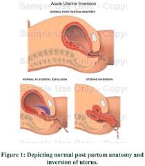 Image result for Uterine Inversion