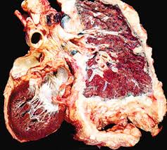 This page was updated on april 2, 2021. Malignant And Borderline Mesothelial Tumors Of The Pleura Sciencedirect