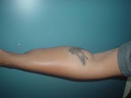 Hair removal wide choice of solutions for everyone deka offers a wide selection of wavelengths that represents the very latest for hair removal technology: Tattoo Removal Egypt Tattoo Design
