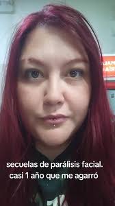 Paralisis Facial Vanessa 4k