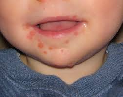 The red spots will usually appear on the soles of the feet. Hand Foot And Mouth Disease Wikipedia
