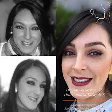 Rinoplastia en Mujeres » ORL FACE