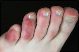 Jun 28, 2021 · major symptoms of the delta plus variant as listed are cough, diarrhoea, fever, chest pain, shortness of breath, headache, skin rash, discolouration of fingers and toes. Covid 19 Symptoms In The Feet