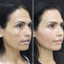 TOP 10 BEST Neck Lift in Brea, CA