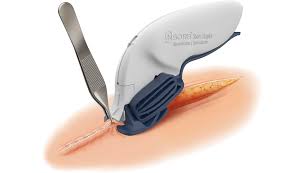 Explain the procedure to patient, address concerns, and obtain their verbal consent to remove the staples. Insorb Absorbable Subcuticular Skin Stapler For Incisions