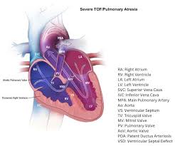 Image result for Ventricular Septal Defect