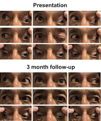 Image result for Pupillary Paralysis