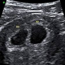 Twin Fetal Development A Closer Look At Your Developing Babies Twins Ultrasound Baby Ultrasound Pictures First Ultrasound