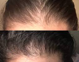 However, androgenetic alopecia (male pattern baldness) affects a specific area of the scalp and therefore is better treated with a dht blocker. This Biotin Shampoo S Before And After Photos Will Have You Believing In Miracles