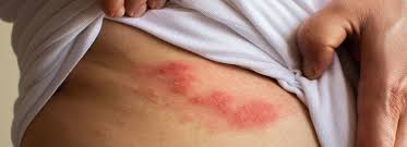 Image result for shingles