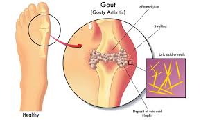 Image result for gout symptoms toe