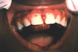 Image result for granuloma gum disease