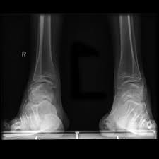Lexikon der syndrome und fehlbildungen.ursachen, genetik, risiken (7. Charcot Marie Tooth Disease Radiology Reference Article Radiopaedia Org
