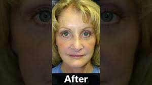 Best Facelift Surgeon in Michigan