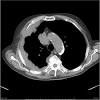 These guidelines for the diagnosis and treatment of malignant pleural mesothelioma systematise the approach to the management of mpm based on the best available evidence in accordance with standards to the assessment of evidence developed by the national health and medical research council in 2011(1). 1