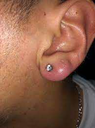 Help Is My Lobe Infected Or Rejecting Piercing