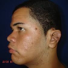 PDF) Keloid of Ears: Recurrence and Its Complications