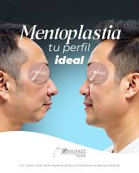 Para mí, un perfil armónico es la clave para un rostro equilibrado y una  confianza inigualable 👨‍⚕️✨. Hoy quiero que hablemos de la Mentoplastia.  Con esta cirugía, ajusto tu mentón para una
