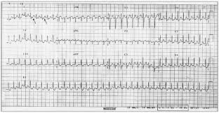 Figure 1 shows the ecg surface leads during an episode of paroxysmal supraventricular tachycard figure 2 shows continuous ecg tracing recorded upon termination of psvt with an intradv venous. Example Of Psvt With Arrows Showing The Location Of P Waves In The St Download Scientific Diagram