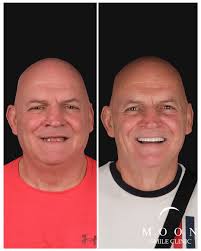 🦷➡️ Swipe to See This Stunning Transformation! Ready for your own smile  makeover? Let's chat! 📞+905303130520 📞+905454995159 📞+905324995159  #dentaloffice #dentaltok #implant #implantdentures #zircônias  #zirconiacrown #emax #emaxpress #emaxveneers ...