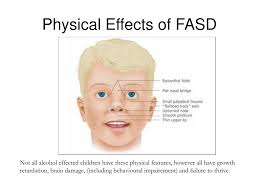 It is also seen in some native american peoples and occasionally in europeans (e.g., scandinavians. Ppt Fetal Alcohol Spectrum Disorder Fasd Powerpoint Presentation Free Download Id 974671