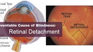 If untreated, perma­nent loss of vision may occur. Retinal Detachment Risks The Frauenfeld Clinic