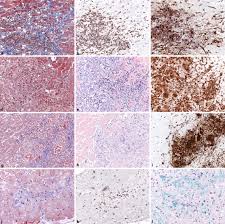 Senckenbergischen anatomie des fachbereichs medizin der j. Myokarditis Update Springerlink