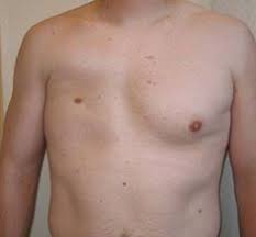 Poland syndrome is characterized by an underdeveloped or absent chest muscle on one side of the body. 900 Nursing Medical Ideas Medical Nursing Study Nursing Notes