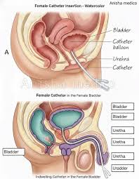 Image result for Urethral Catheterization