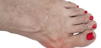 Image result for gout symptoms toe