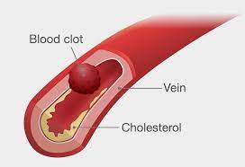 Postpartum Bloot Clot Causes Signs Treatment