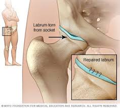 Hip Labral Tear Hip Surgery Recovery Hip Injuries Torn Labrum Hip
