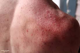 Image result for folliculitis symptoms
