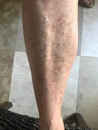 Image result for liver spots on legs