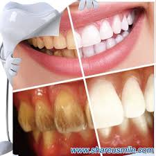 While you can't safely remove tartar at home, with an excellent oral hygiene routine, plaque removal can be done by following these steps: Oral Care Official Teeth Cleaning Kit Professional At Home Teeth Whiten