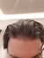 Celebrity Thinning Hair