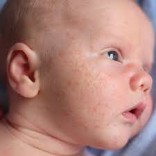 Newborn Baby Acne Causes And Treatment